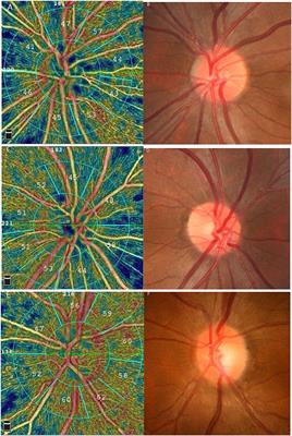 Analysis of Optic Nerve in Adults With Amblyopia Using OCTA